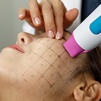 Thermage FLX