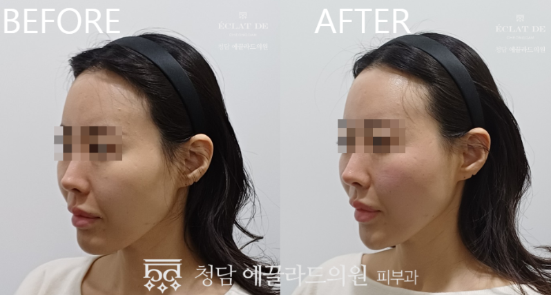 EMFACE- Before & After  from Eclat de 
