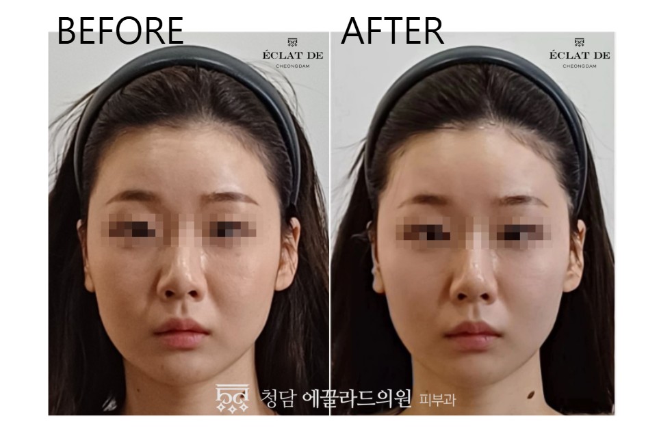 ONDA FACE-  Before & After from Eclat de 