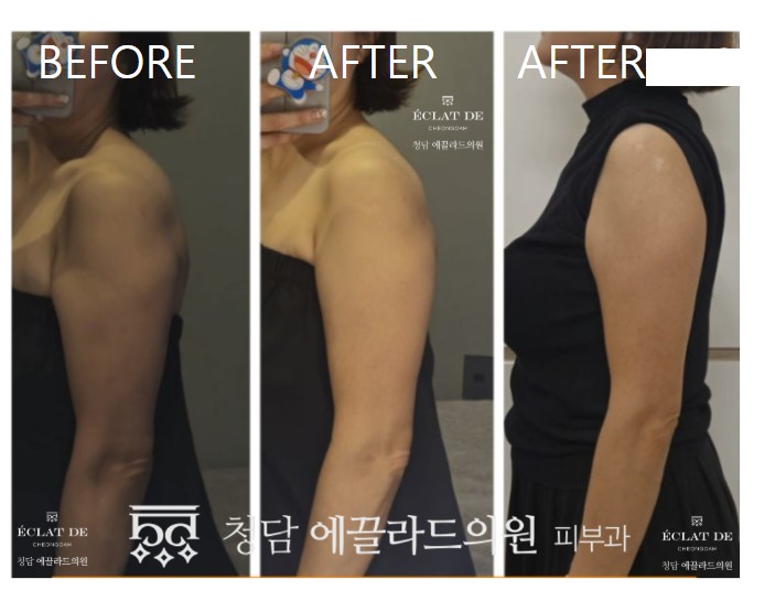ONDA Body – Before & After from Eclat De