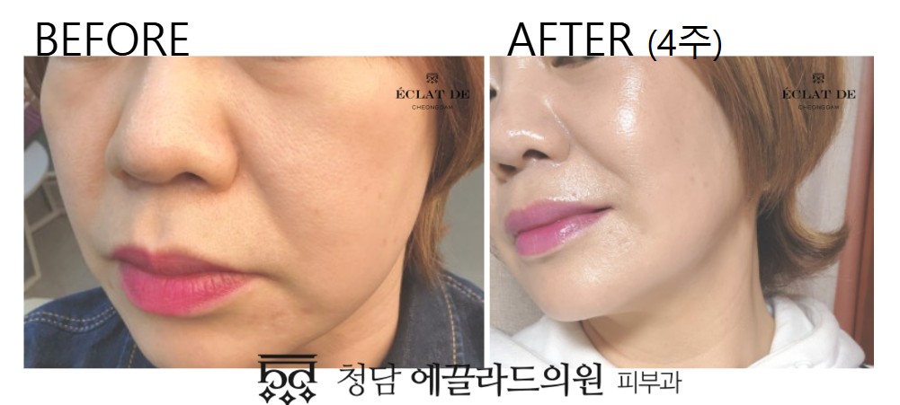 Juvelook Skin – Before & After from Eclat De