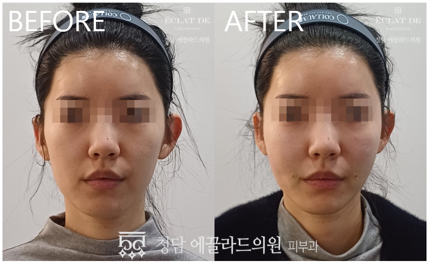 Juvelook Skin – Before & After from Eclat De