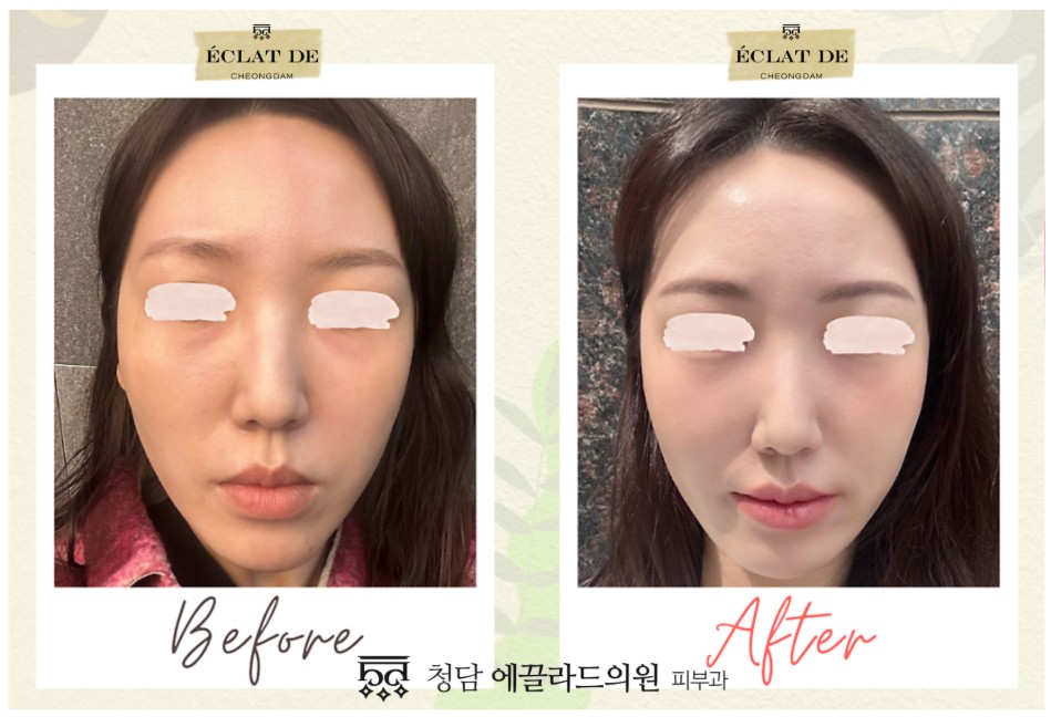 Ultracol 200 – Before & After from Eclat De