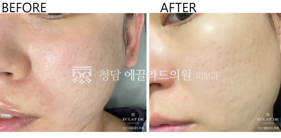 Ellisys Sense – Before & After from Eclat De