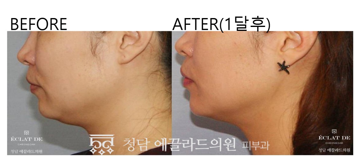 Ultherapy Prime – Before & After from Eclat De
