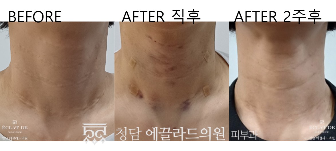 Radiesse – Before & After from Eclat De
