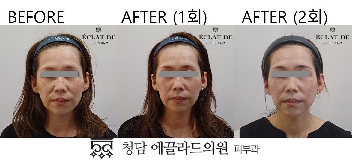 Dual Toning – Before & After from Eclat De