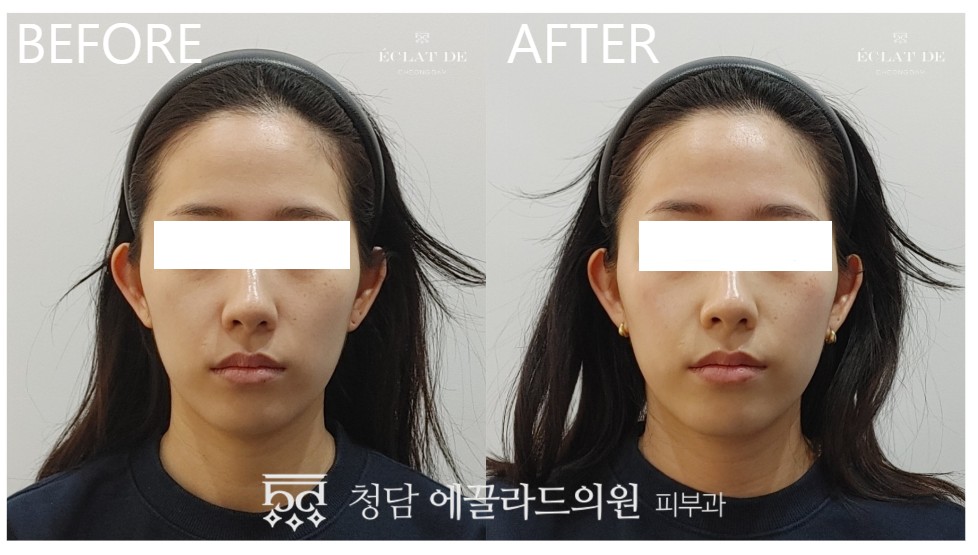Oligio X – Before & After from Eclat De