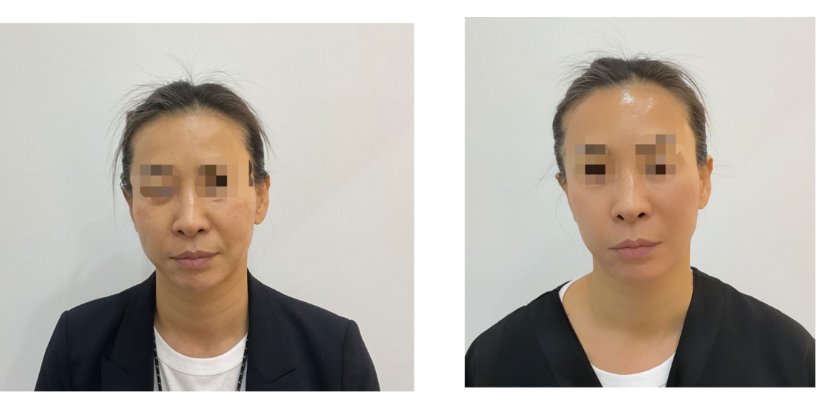 Thermage FLX – Before & After from Eclat De