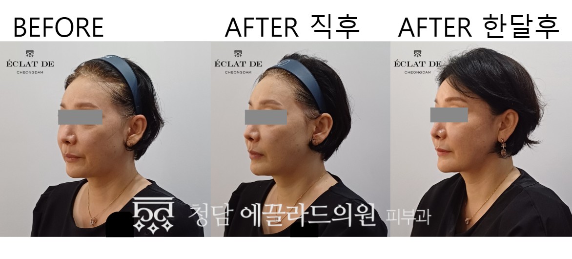 Titanium Lifting – Before & After from Eclat De