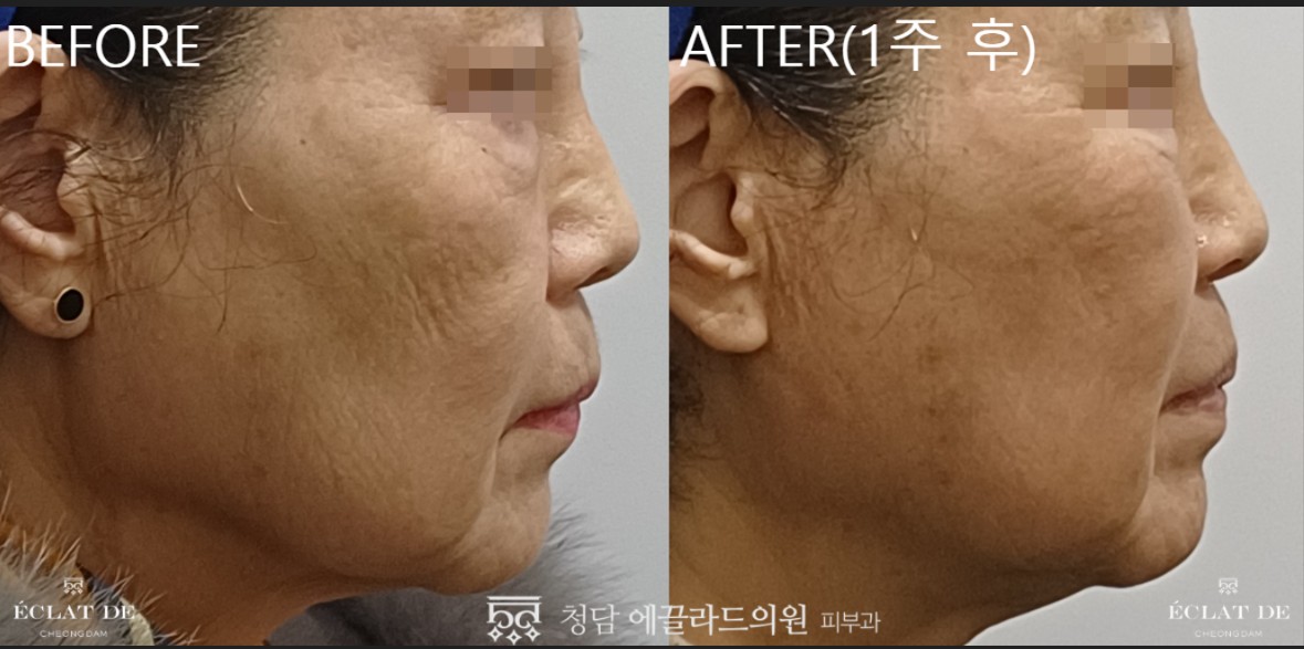 Ultra Clear : Smoother Skin, Refined Texture & Visible Elasticity