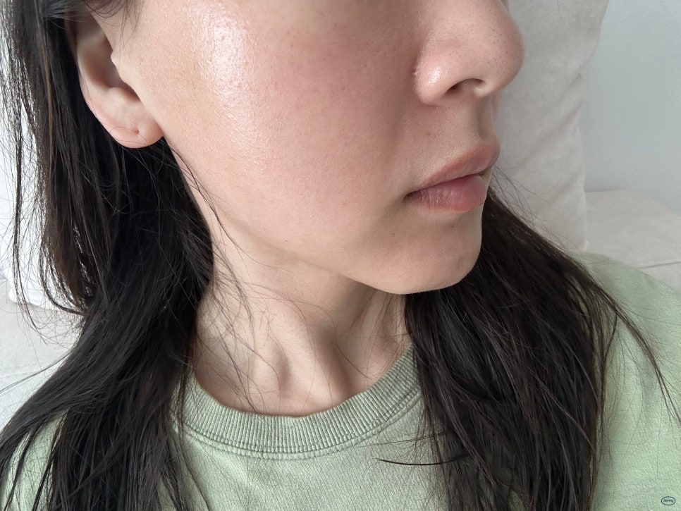 Honest Review of Ultra Clear Laser (Pain, Downtime & Results)
