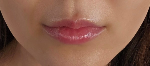 Honest Review: Lip Filler + Corner Lip Botox 