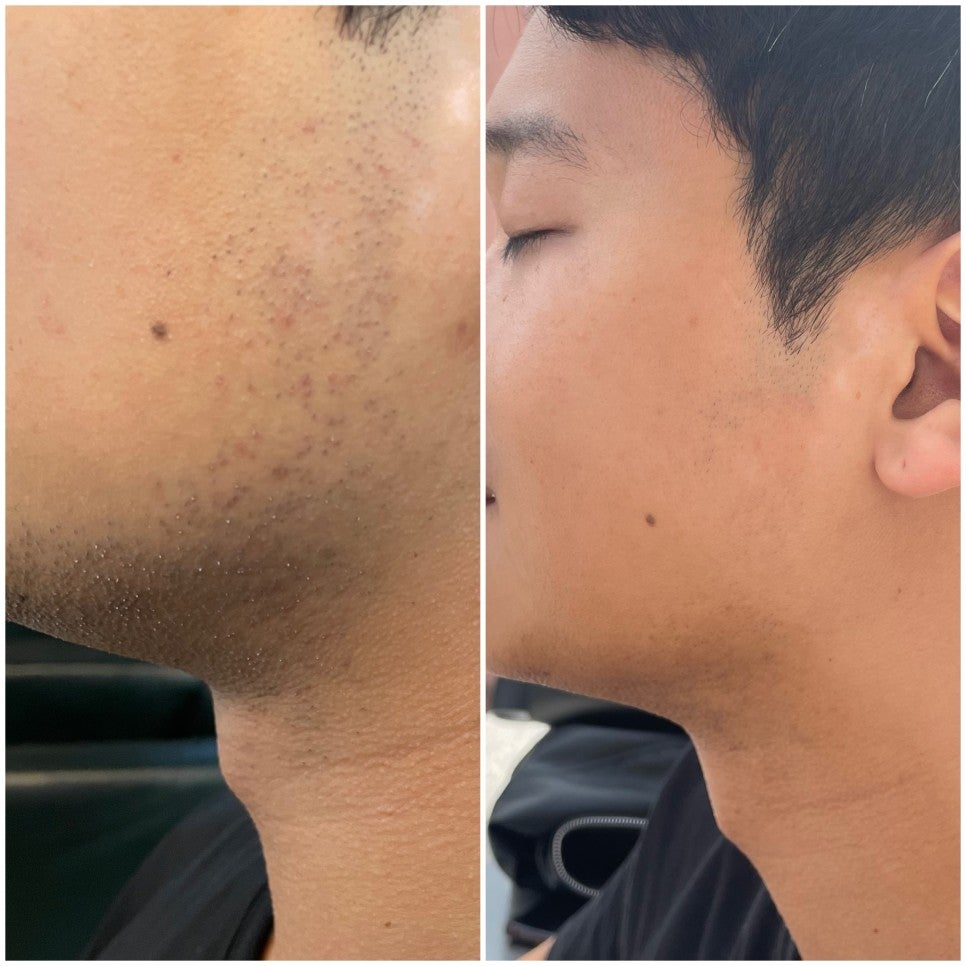  Men’s Facial Hair Removal Review – 6th Session 