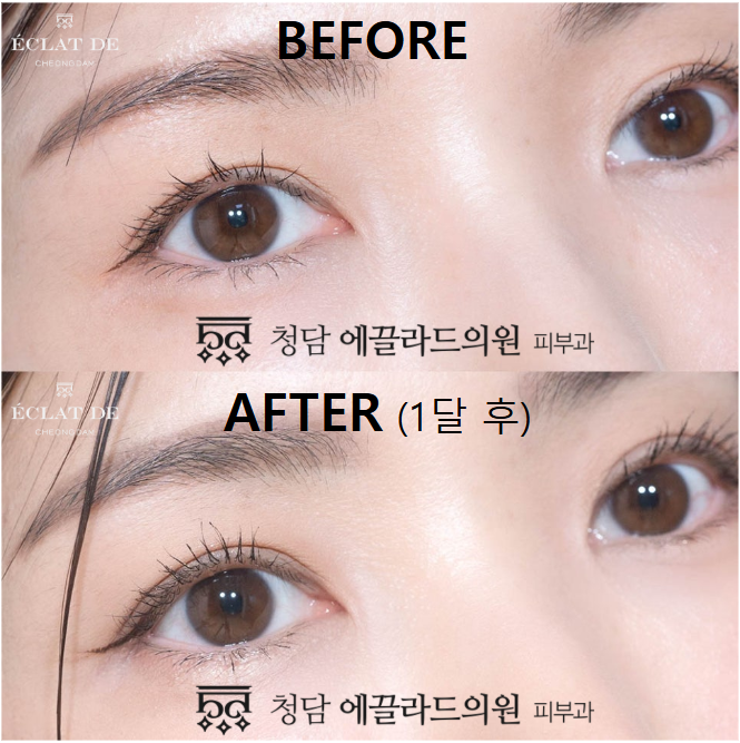 Eye Ulthera- Before & After from Eclat De