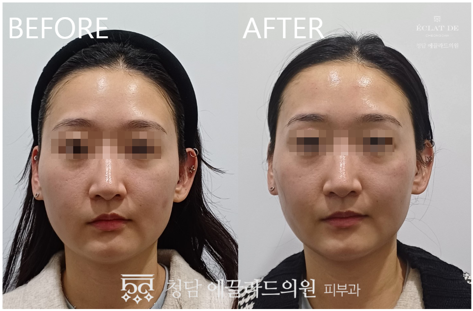  Geneo X- Before and After  from Eclat De