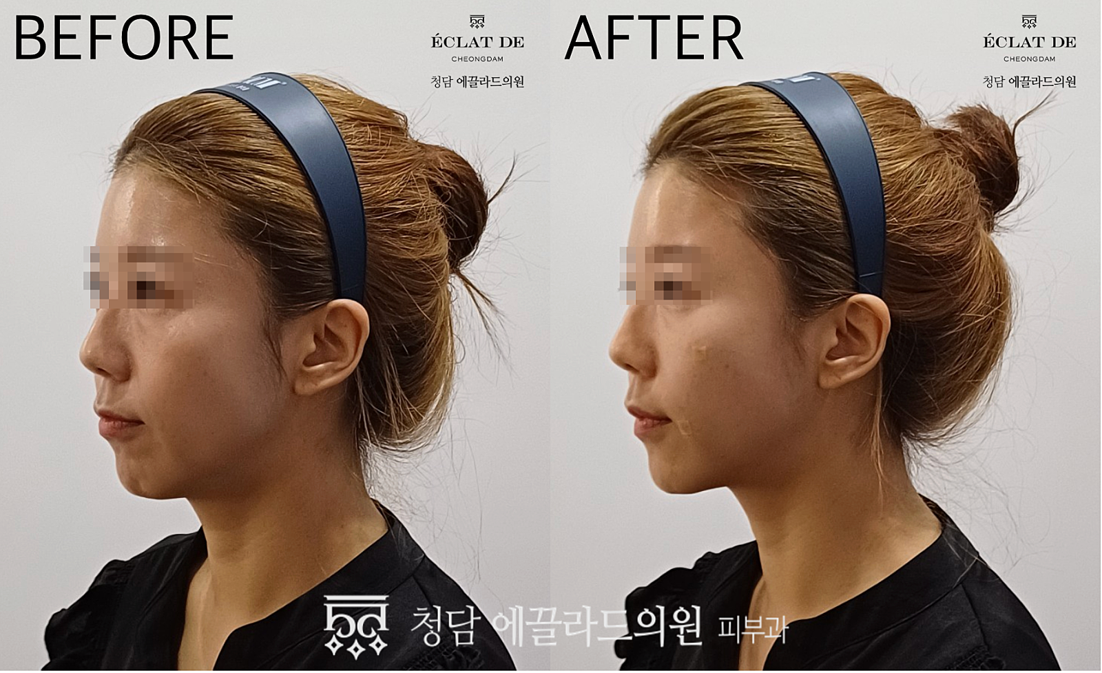 Juvelook Volume- Before & After from Eclat de