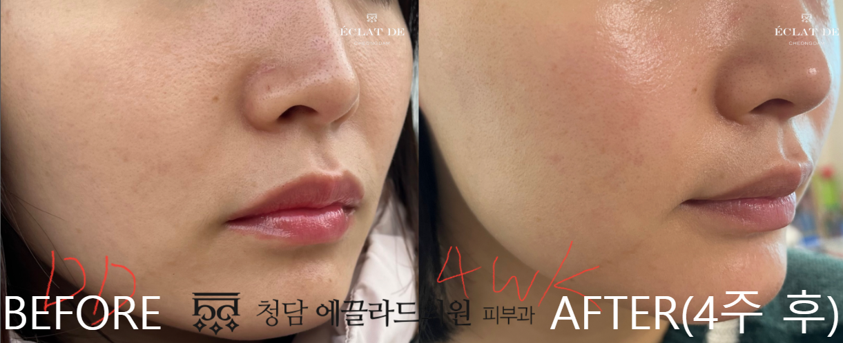 UltraClear-  Before & After from Eclat De