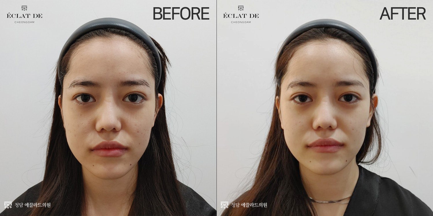 Dual Toning-Before and After from Eclat De