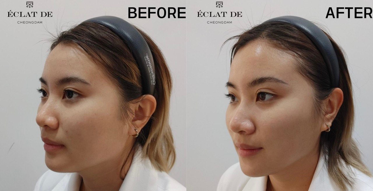 Rejuran - Before and After from Eclat De