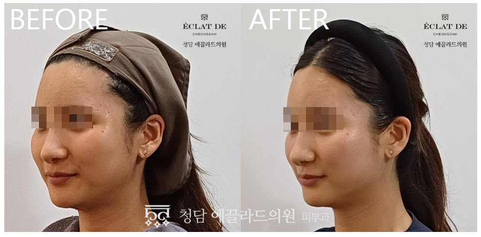 Doublo Gold  - Before and After from Eclat De