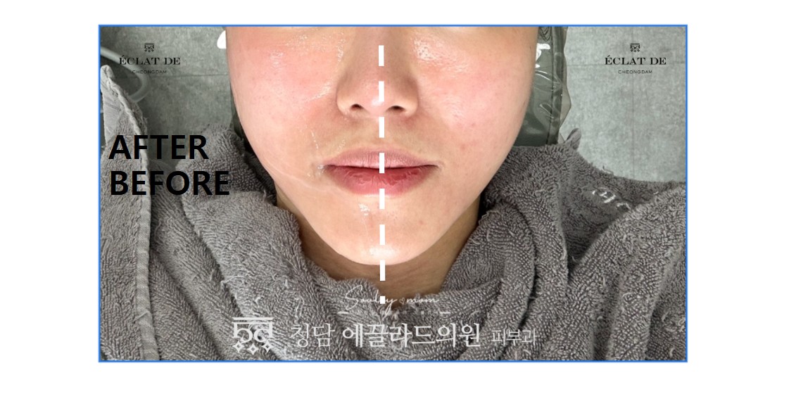 Oligio X – Before & After from Eclat De