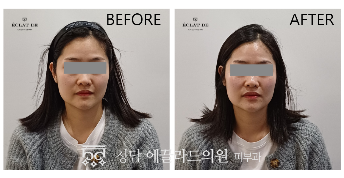 Oligio X – Before & After from Eclat De