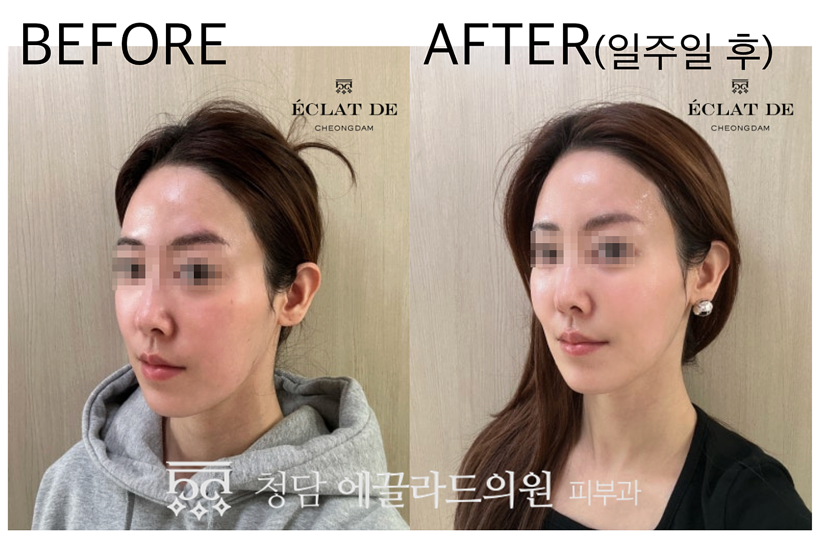 Ultracol 100 – Before & After from Eclat De