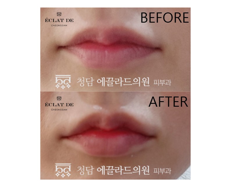 Lip Filler - Before & After from Eclat De