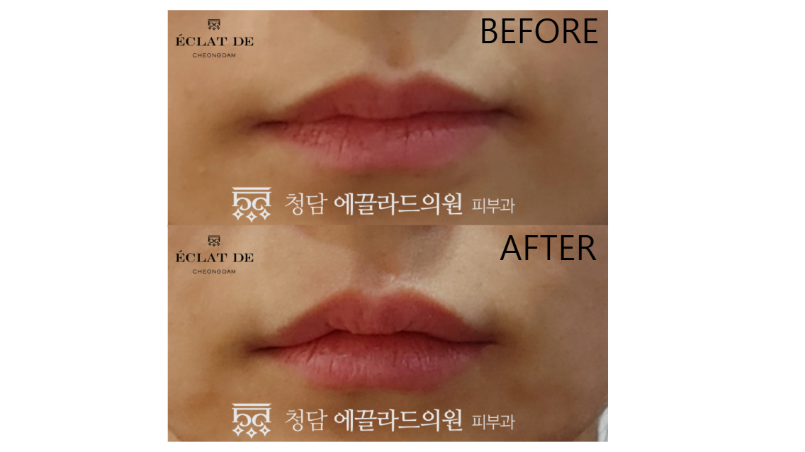 Lip Filler - Before & After from Eclat De