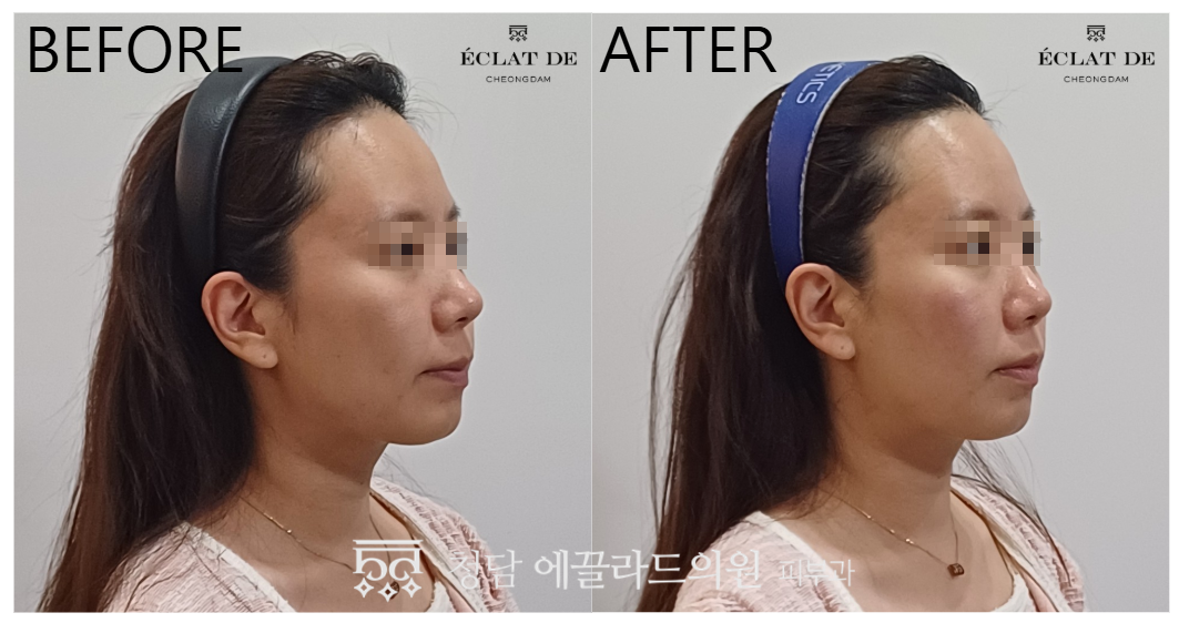 Titanium Lifting 80KJ – Before & After from Eclat De