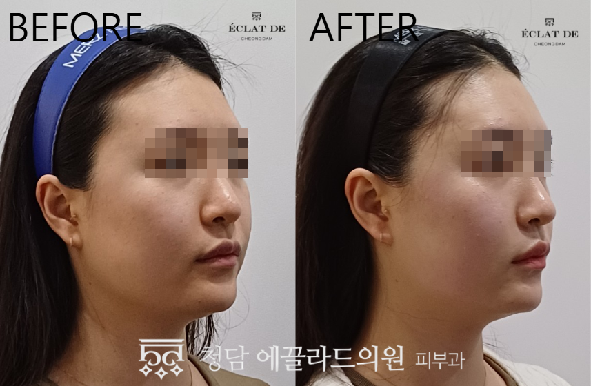 Thermage FLX 300 Shots- Before & After from Eclat De