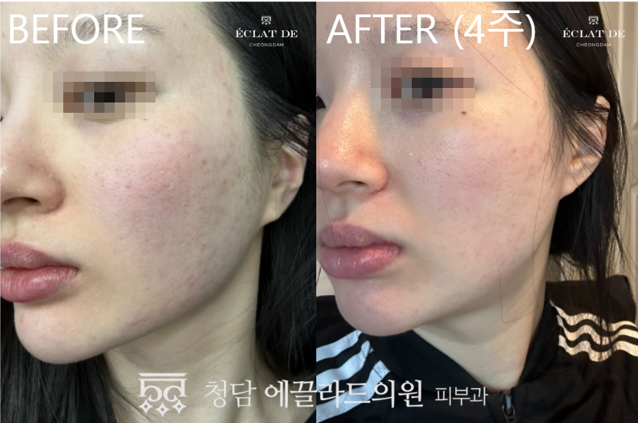 Ellisys Sense – Before & After from Eclat De