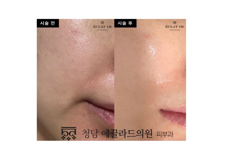 Skin Botox- Before & After from Eclat De