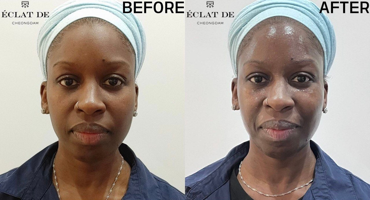 Skin Botox- Before & After from Eclat De