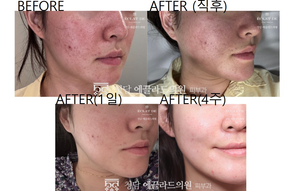 SSOLA PDT-Before & After from Eclat De