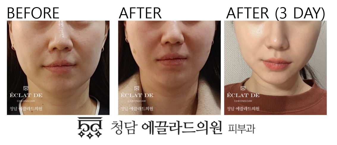Cheek Fillers- Before & After from Eclat De