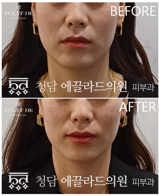 Ultherapy Prime – Before & After from Eclat De