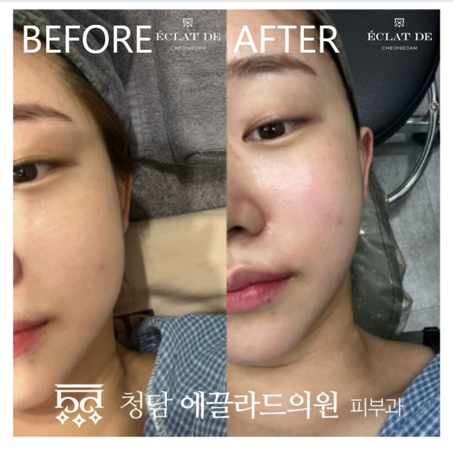 ONDA FACE- Before & After from Eclat de