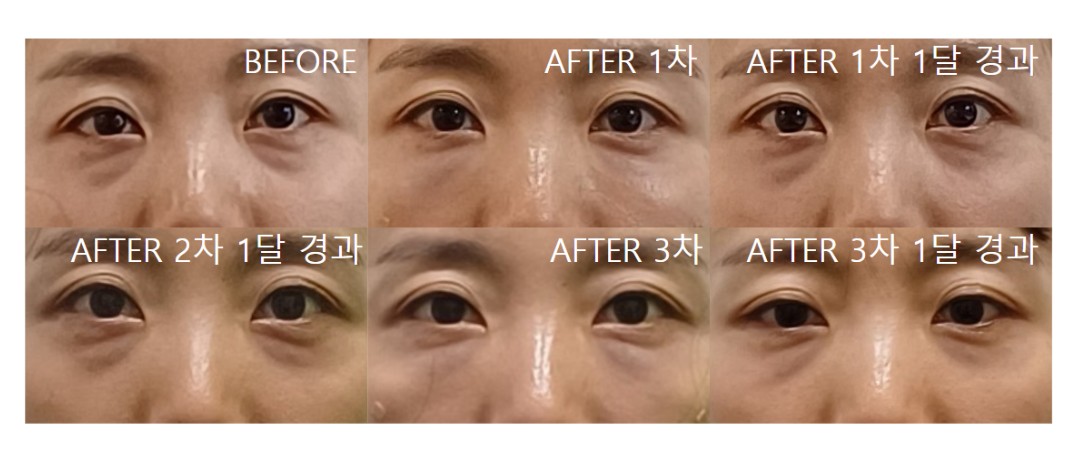 Ultracol 200 – Before & After from Eclat De