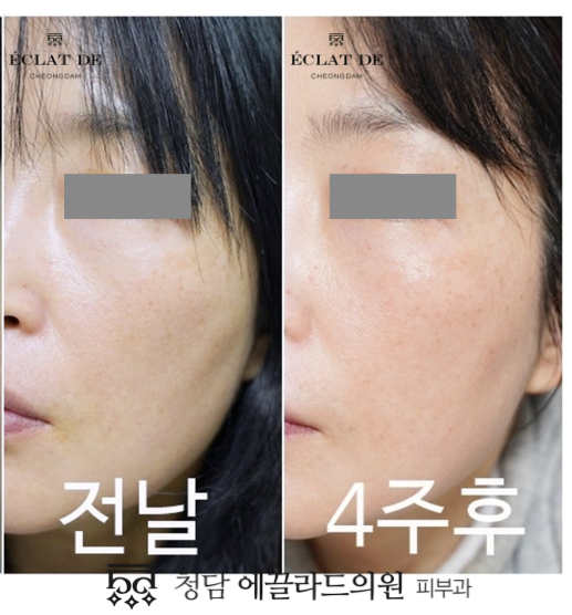 Ultracol 200 – Before & After from Eclat De