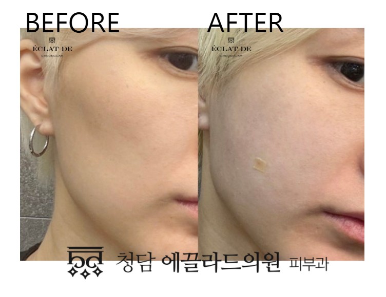 Juvelook Volume- Before & After from Eclat de