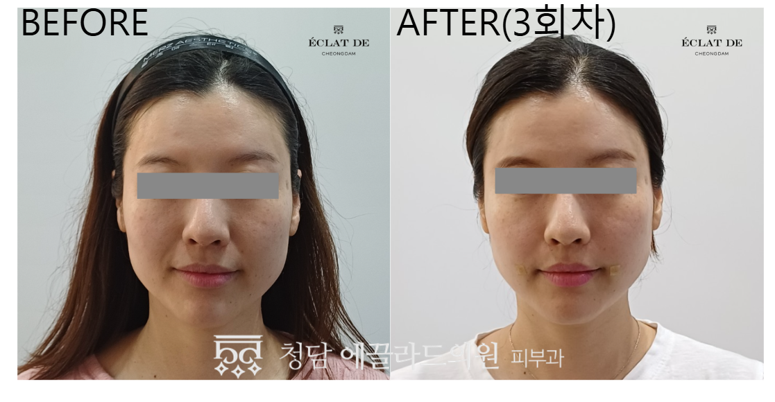 Juvelook Volume- Before & After from Eclat de