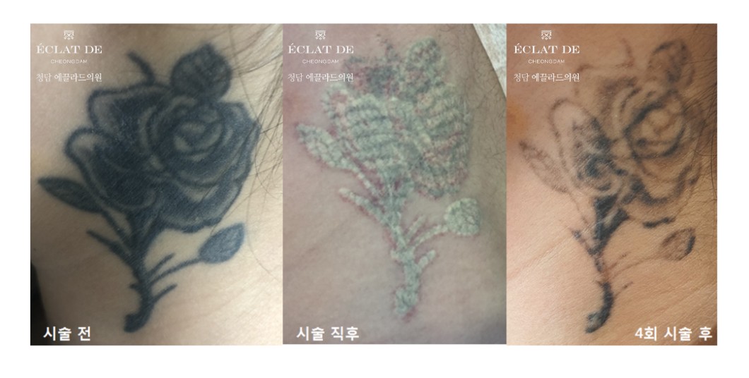 Tattoo Laser-Before & After from Eclat de