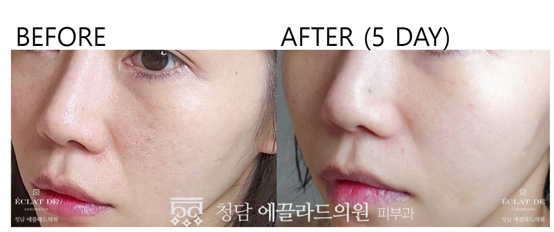Rejuran - Before and After from Eclat De