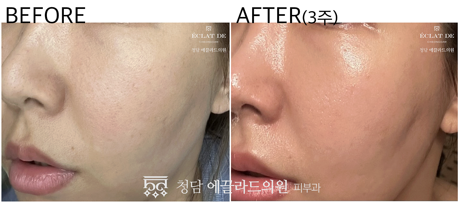 Re2O- Before and After from Eclat De