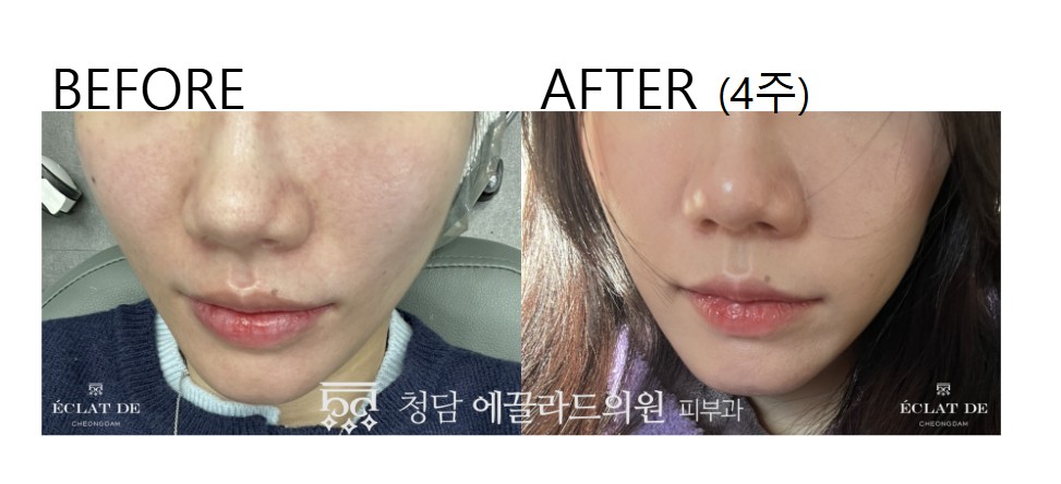 Ellisys Sense – Before & After from Eclat De