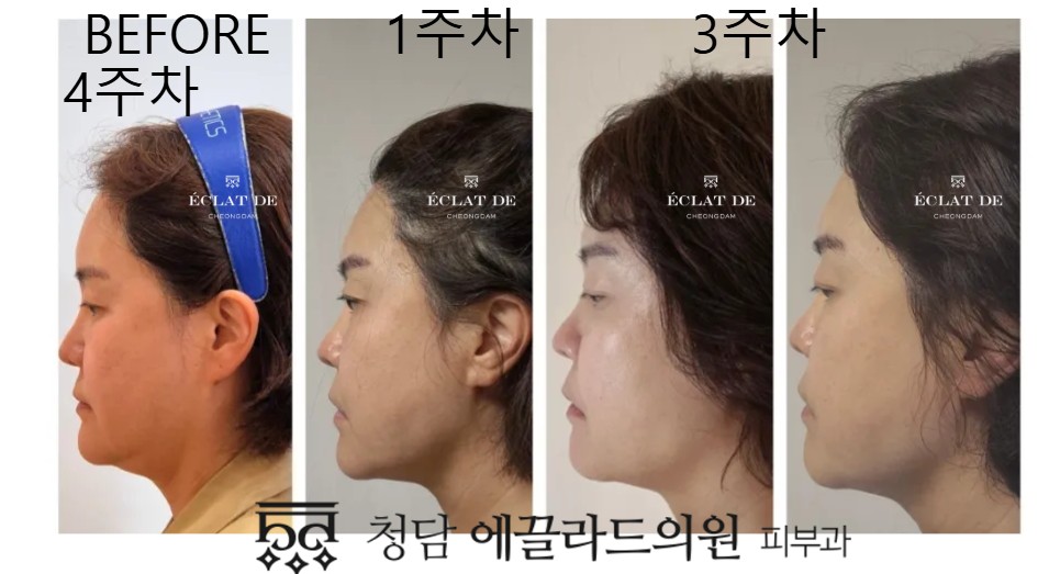 Ultherapy Prime – Before & After from Eclat De