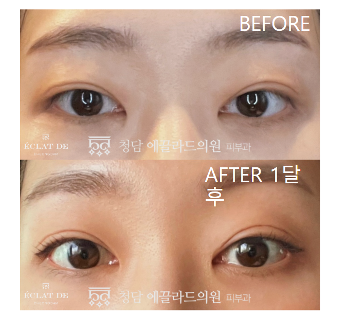 Eye Ulthera- Before & After from Eclat De