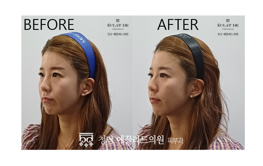 Juvelook Volume- Before & After from Eclat de
